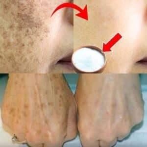 Cómo reduje mis manchas de la edad: El poder del bicarbonato de sodio 2 Cómo reduje mis manchas de la edad