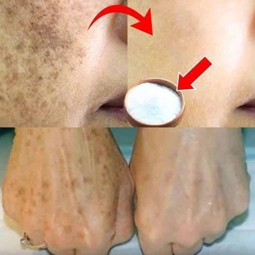 Cómo reduje mis manchas de la edad