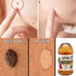 Formas naturales de eliminar lunares de la piel en casa