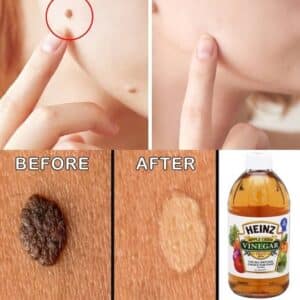 Formas naturales de eliminar lunares de la piel en casa: Remedios caseros efectivos 2 Formas naturales de eliminar lunares de la piel en casa