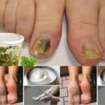 Los hongos en las uñas