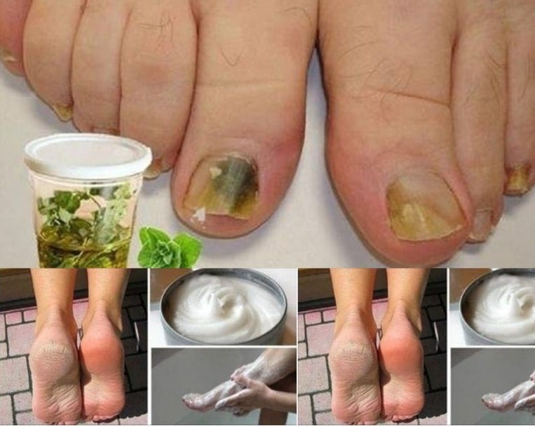 Los hongos en las uñas