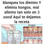 Quita el sarro de tus dientes y blanquéalos