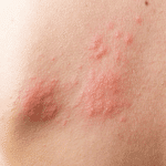Todo sobre el Herpes Zóster