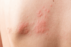 Todo sobre el Herpes Zóster