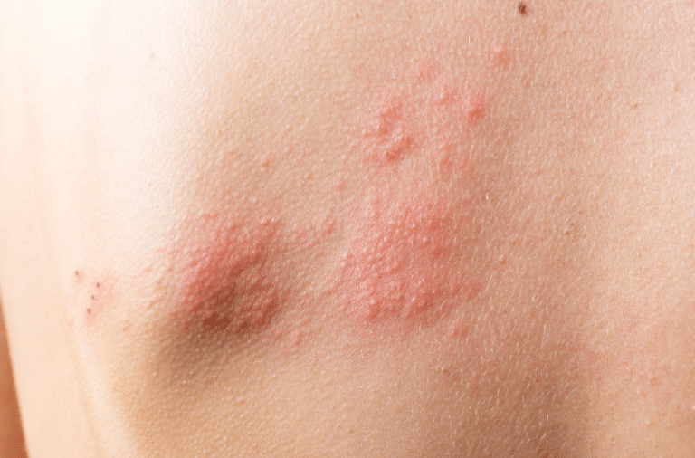 Todo sobre el Herpes Zóster