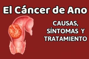 Cáncer de colon: ¿Por qué Afecta Cada Vez a Más Jóvenes? 2 Cáncer de colon
