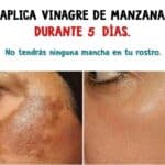 Cómo aclarar y eliminar tus manchas, arrugas y melasma con secretos de belleza 10 Cómo aclarar y eliminar tus manchas, arrugas y melasma