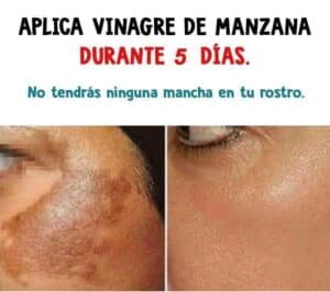 Cómo aclarar y eliminar tus manchas, arrugas y melasma con secretos de belleza 2 Cómo aclarar y eliminar tus manchas, arrugas y melasma