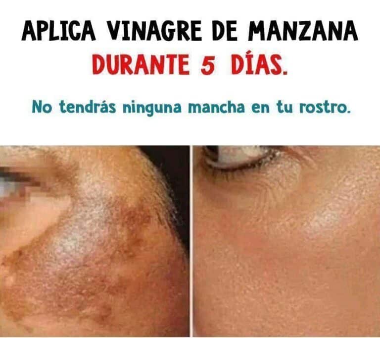 Cómo aclarar y eliminar tus manchas, arrugas y melasma