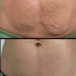 Recoger la Piel Flácida en Casa: Guía Completa de Ejercicios y Cuidados 10 Recoger la Piel Flácida en Casa