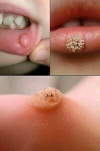 Estos son los primeros signos de un enf: El Arte de Eliminar Verrugas con Remedios Caseros Efectivos 2 Estos son los primeros signos de un enf