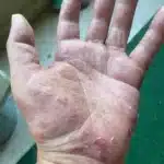 Síndrome de Sweet: Qué es, Causas, Síntomas y Tratamiento Completo 10 702