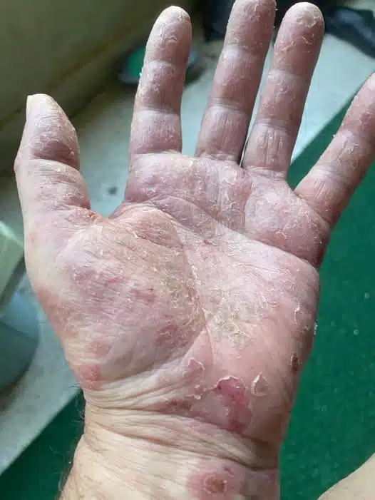 Síndrome de Sweet: Qué es, Causas, Síntomas y Tratamiento Completo 2 702