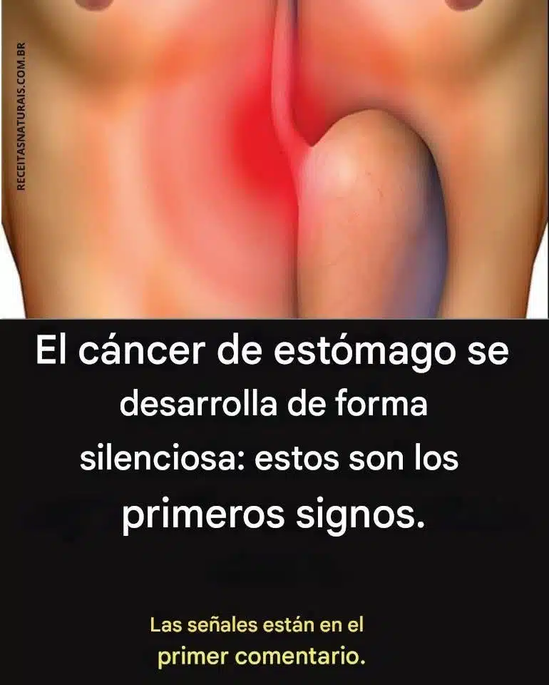 Cáncer de Estómago (Gástrico): Causas, Síntomas, Diagnóstico, Tratamiento y Prevención 2 705